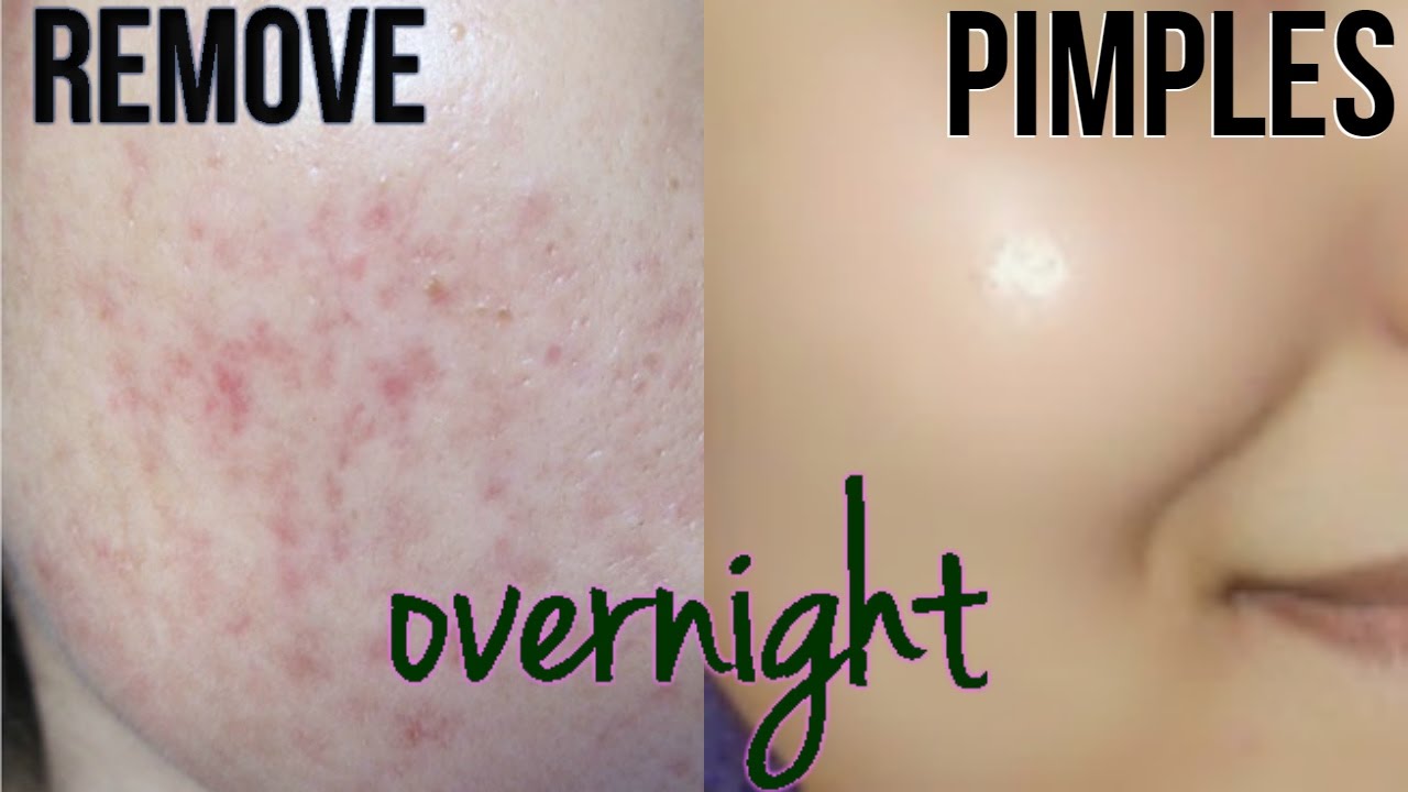 how to get rid of pimples overnight before after